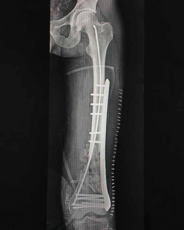 Joint Replacement